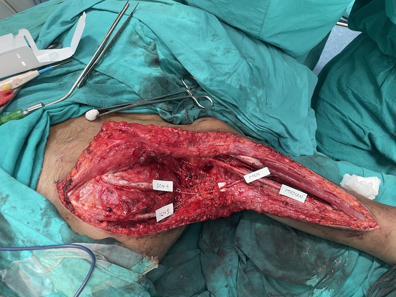 Keyhole_spine_surgery